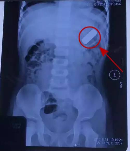 幼儿误吞电池10小时致终身残疾幼儿误吞电池10小时致终身残疾，深度解析与预防策略
